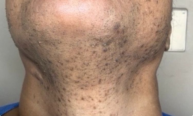 Laser Hair Removal Before & After