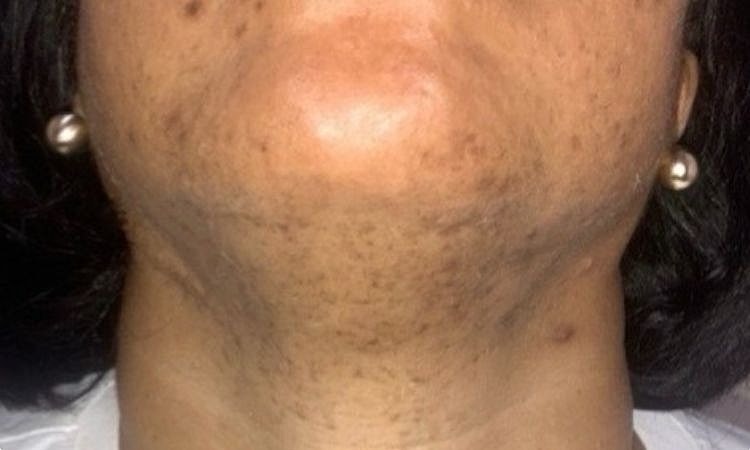 Laser Hair Removal Before & After