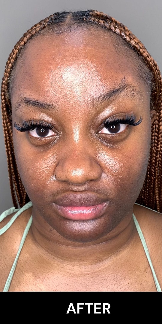 Botox Before & After