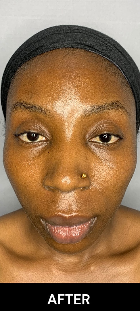 Botox Before & After