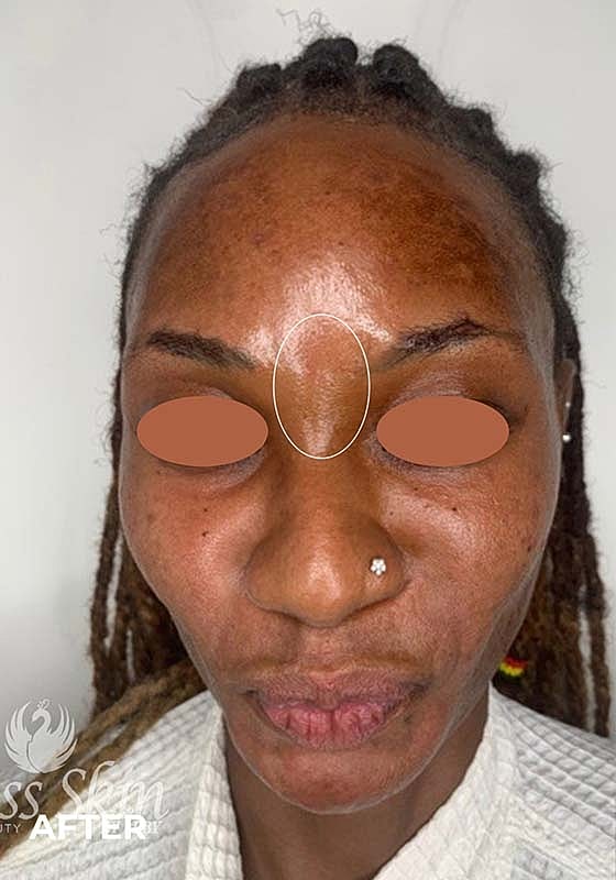 Botox Before & After