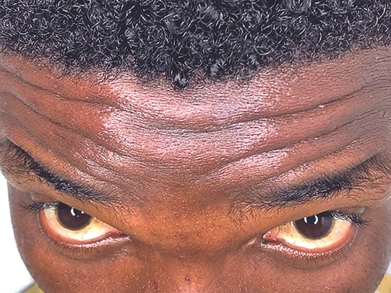 Botox Before & After