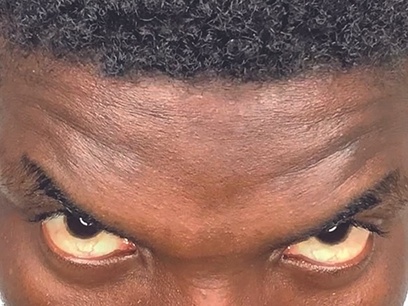 Botox Before & After