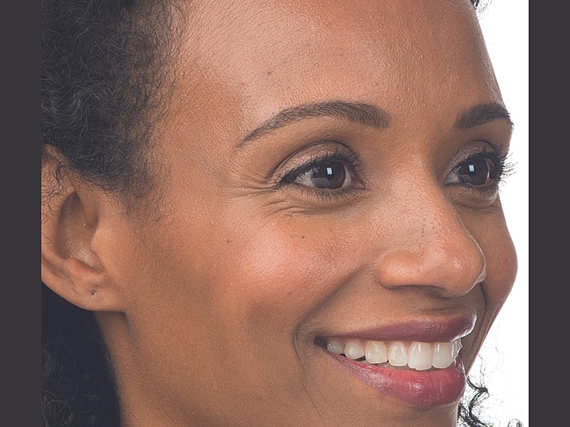 Botox Before & After