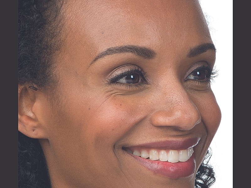 Botox Before & After