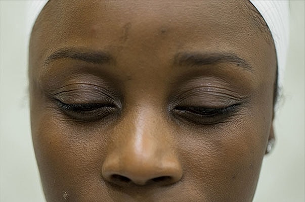 Botox Before & After