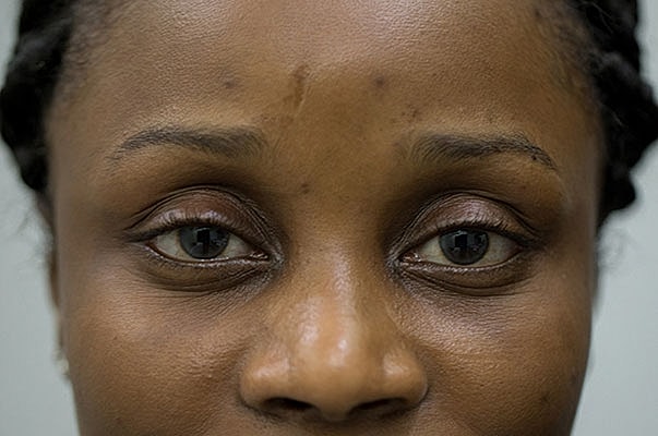 Botox Before & After