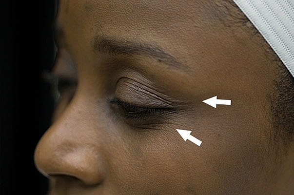 Botox Before & After