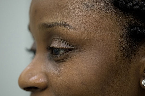 Botox Before & After