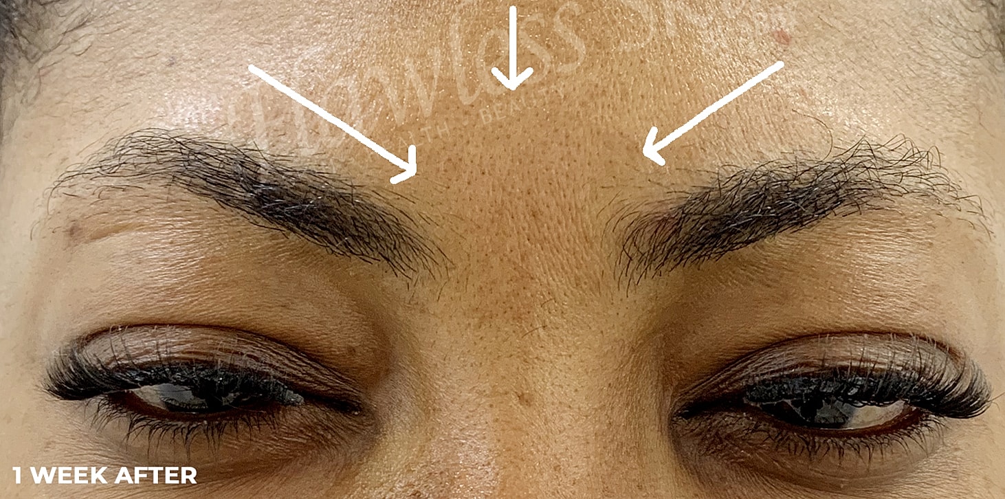 Botox Before & After