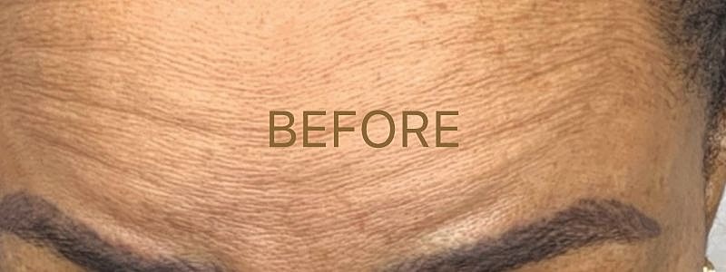 Forehead skin texture before treatment comparison.