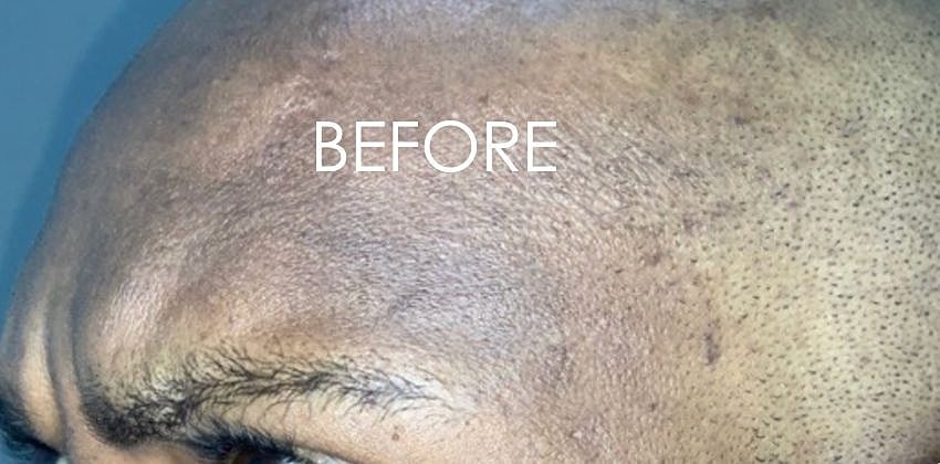 Botox Before & After