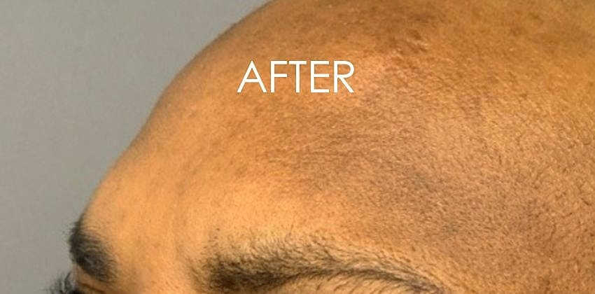 Botox Before & After
