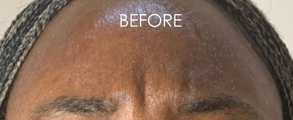 Botox Before & After