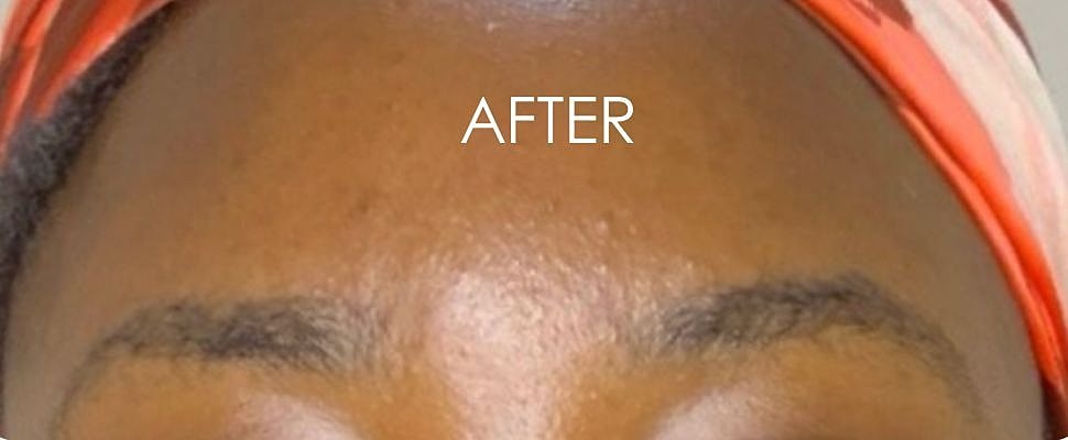 Botox Before & After