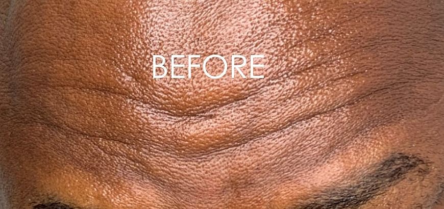 Botox Before & After