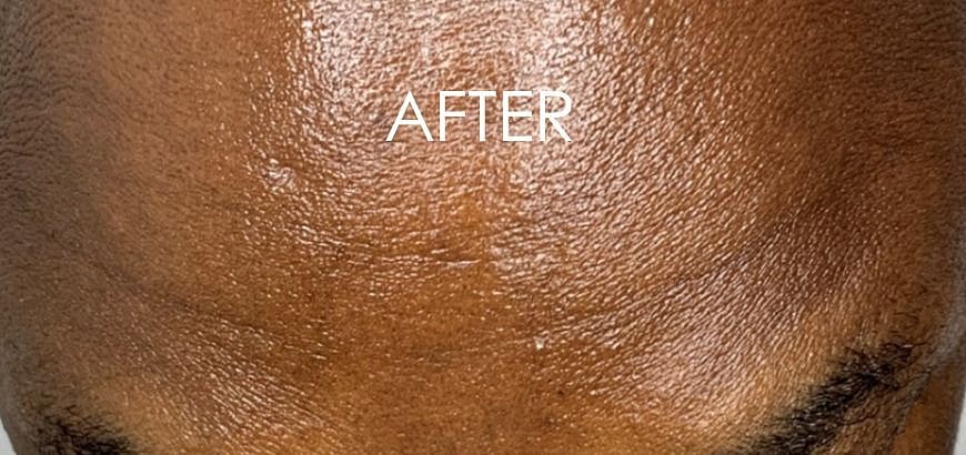 Botox Before & After