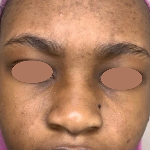 Microneedling Before & After