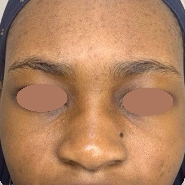 Microneedling Before & After