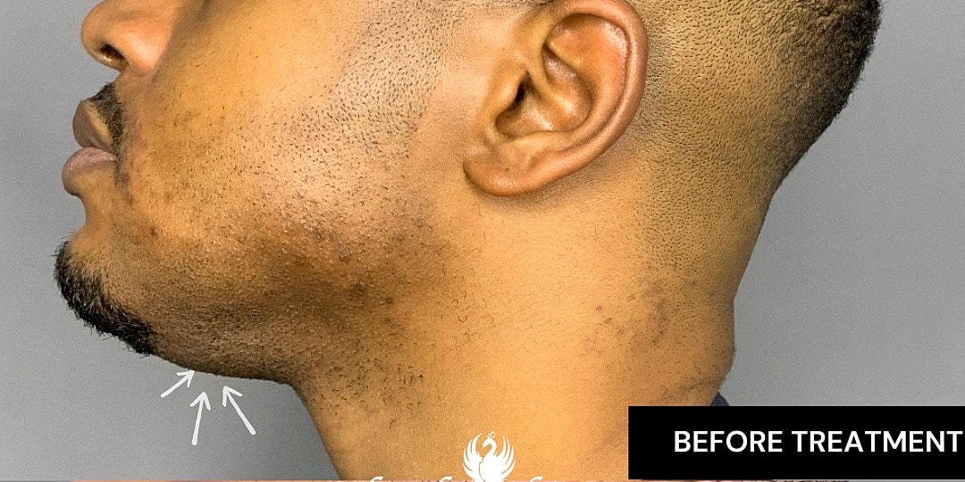 Chin Augmentation And Kybella Before & After