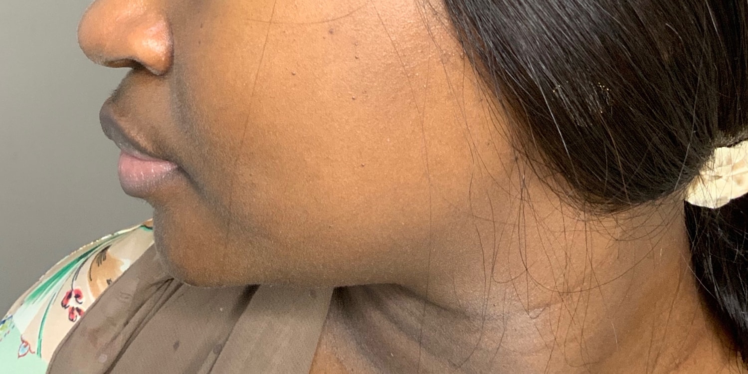 Chin Augmentation And Kybella Before & After