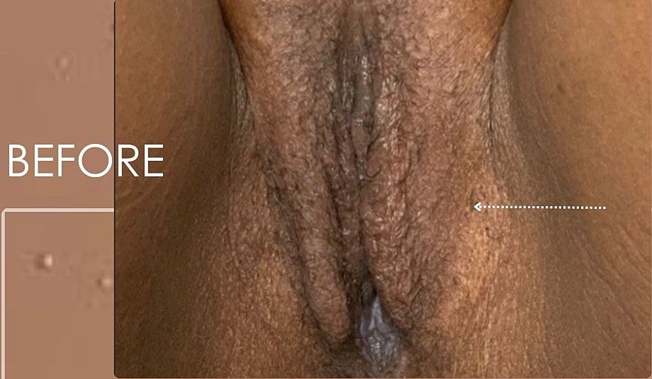 Thermiva And Vaginal Rejuvenation Before & After