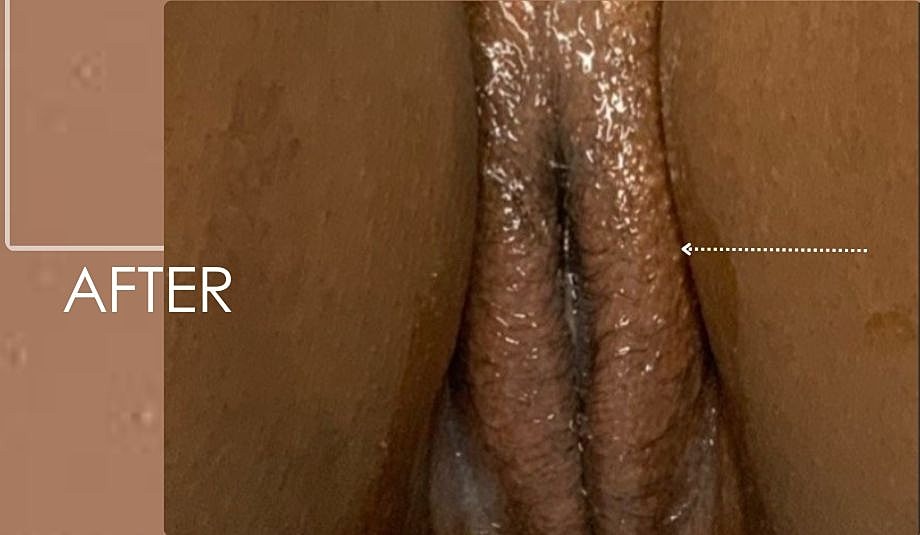Thermiva And Vaginal Rejuvenation Before & After
