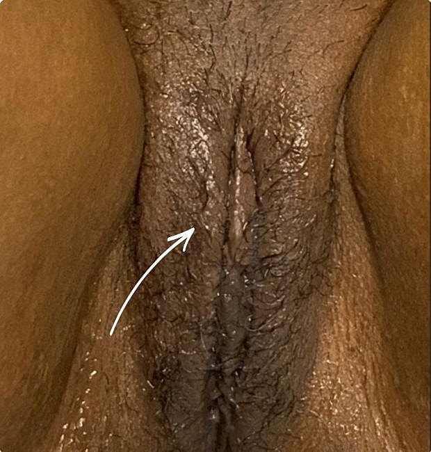Thermiva And Vaginal Rejuvenation Before & After