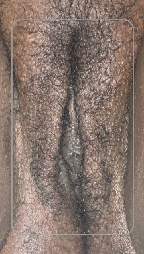 Thermiva And Vaginal Rejuvenation Before & After