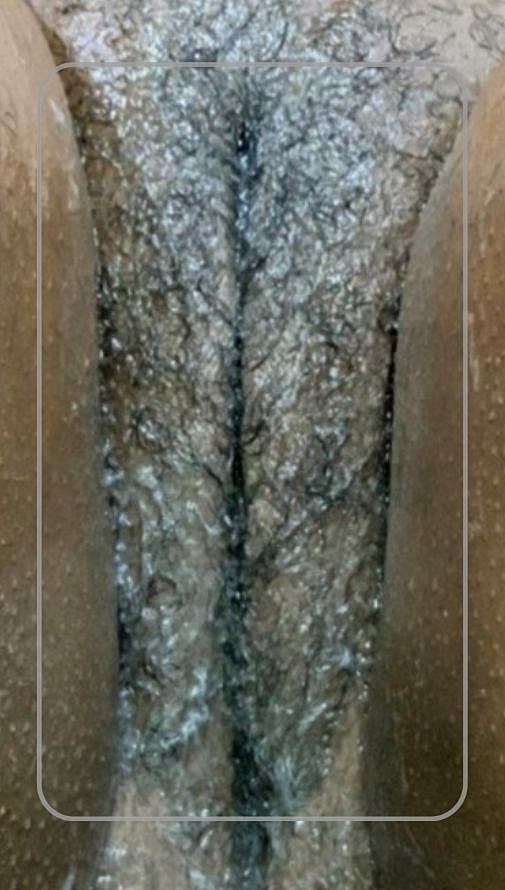 Thermiva And Vaginal Rejuvenation Before & After
