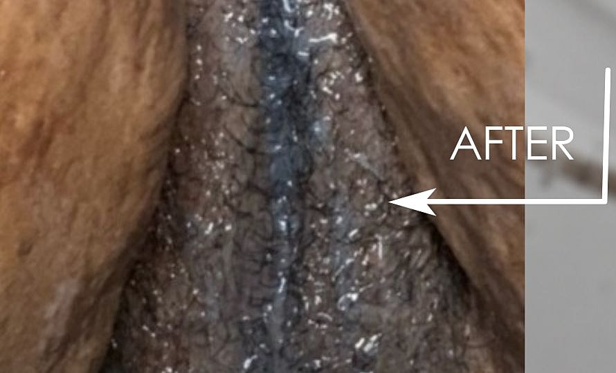 Thermiva And Vaginal Rejuvenation Before & After