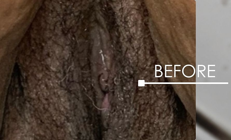 Thermiva And Vaginal Rejuvenation Before & After