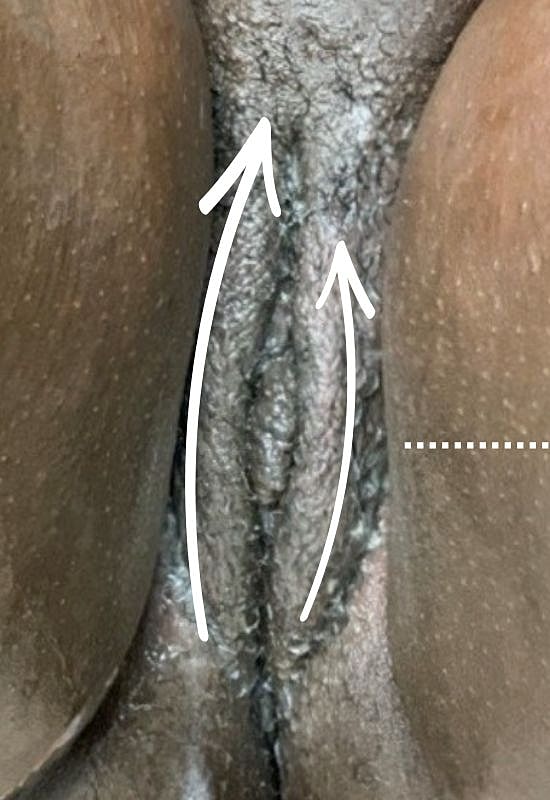 Thermiva And Vaginal Rejuvenation Before & After