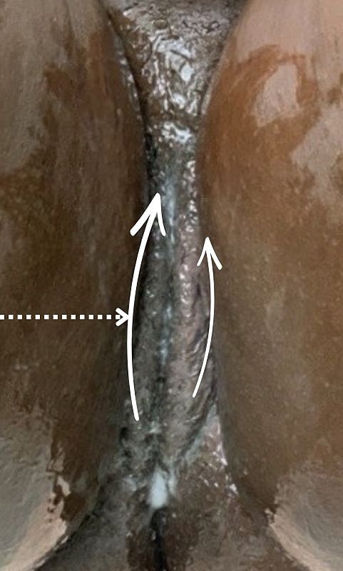 Thermiva And Vaginal Rejuvenation Before & After