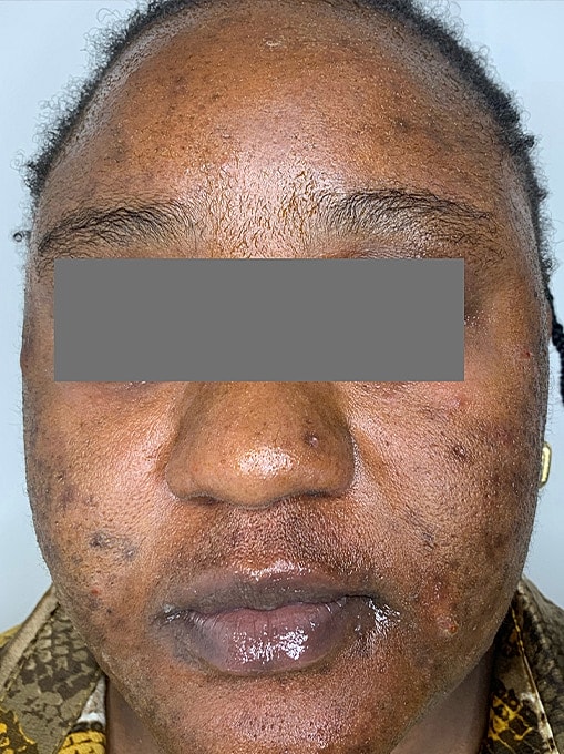 Skin Resurgacing Before & After