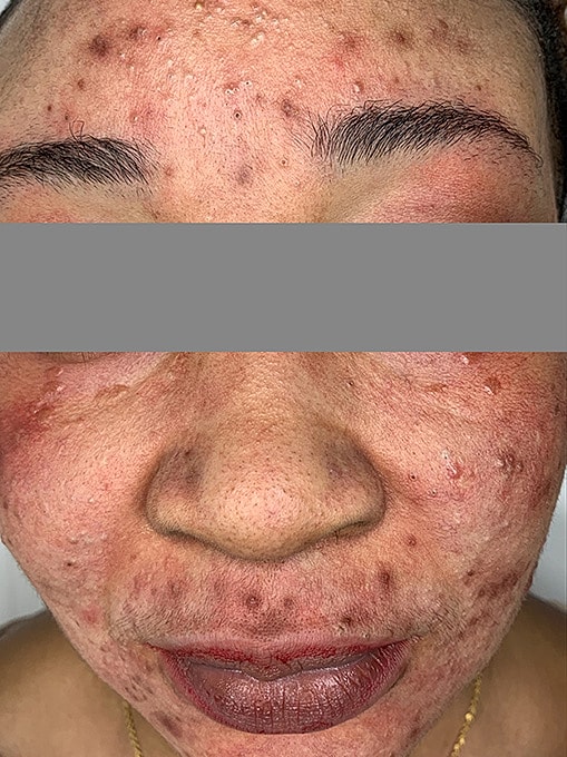 Microneedling With Prp Before & After