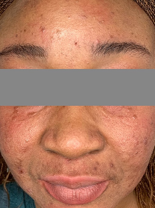 Microneedling With Prp Before & After