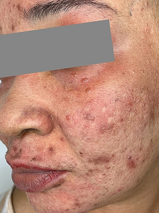 Microneedling With Prp Before & After