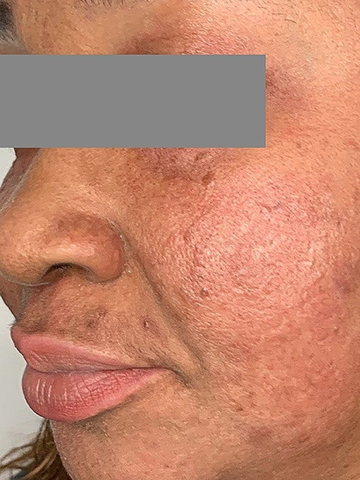 Microneedling With Prp Before & After