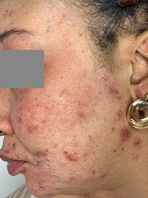 Microneedling With Prp Before & After