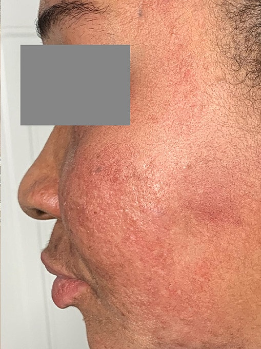Microneedling With Prp Before & After