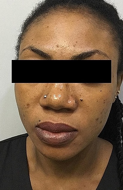 Microneedling With Prp Before & After