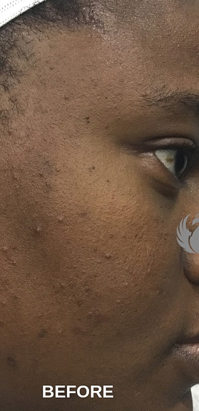 Microneedling With Prp Before & After