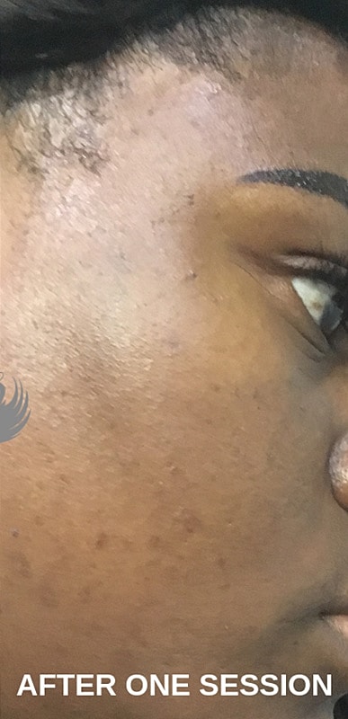 Microneedling With Prp Before & After