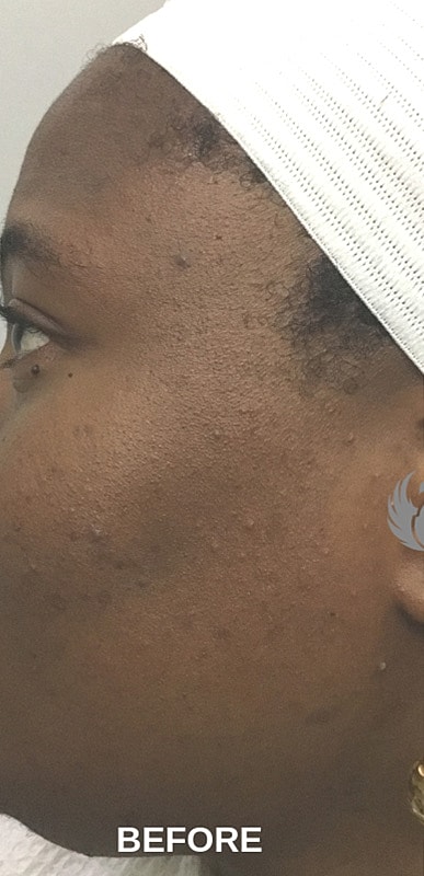 Microneedling With Prp Before & After