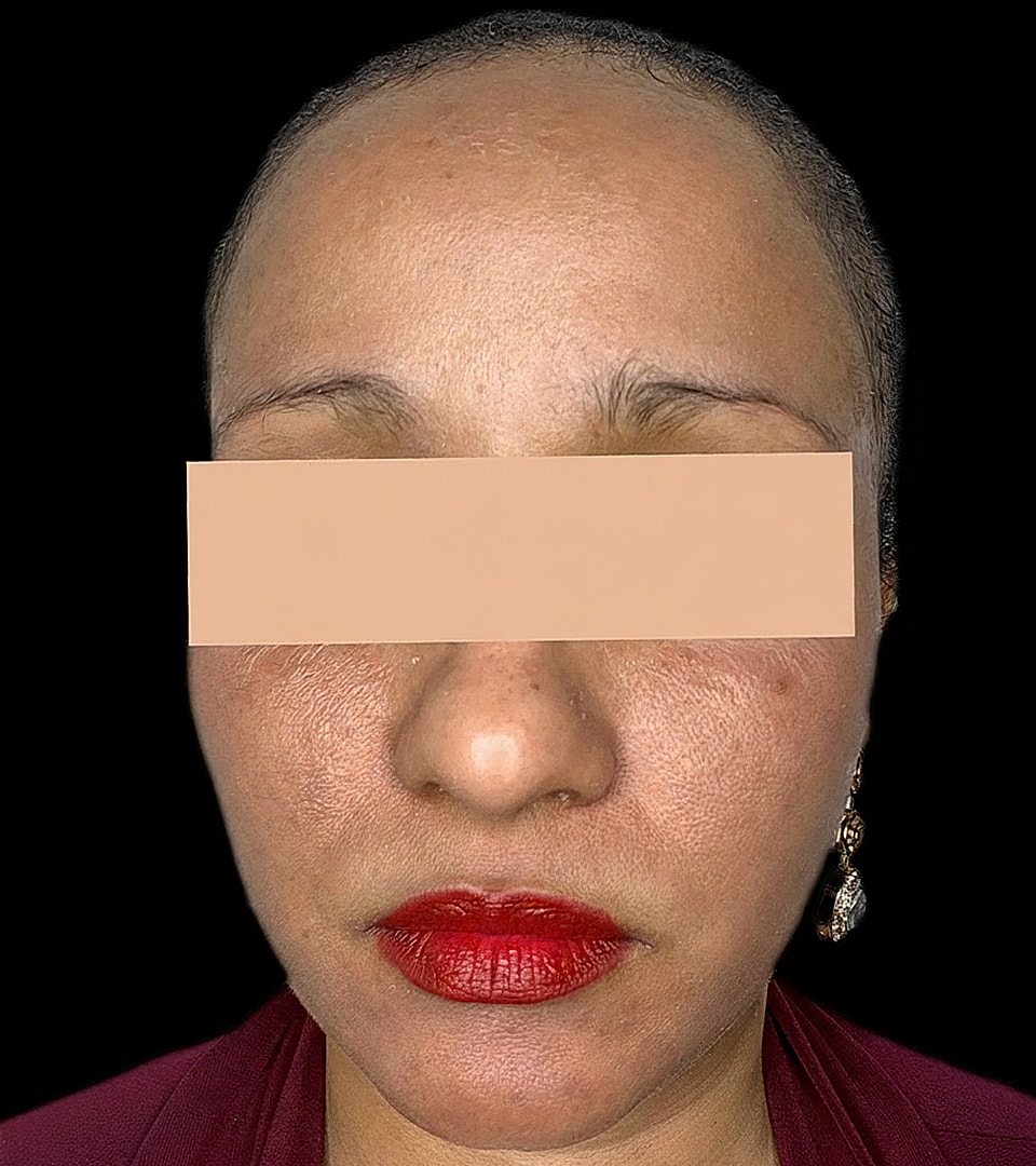Microneedling With Prp Before & After