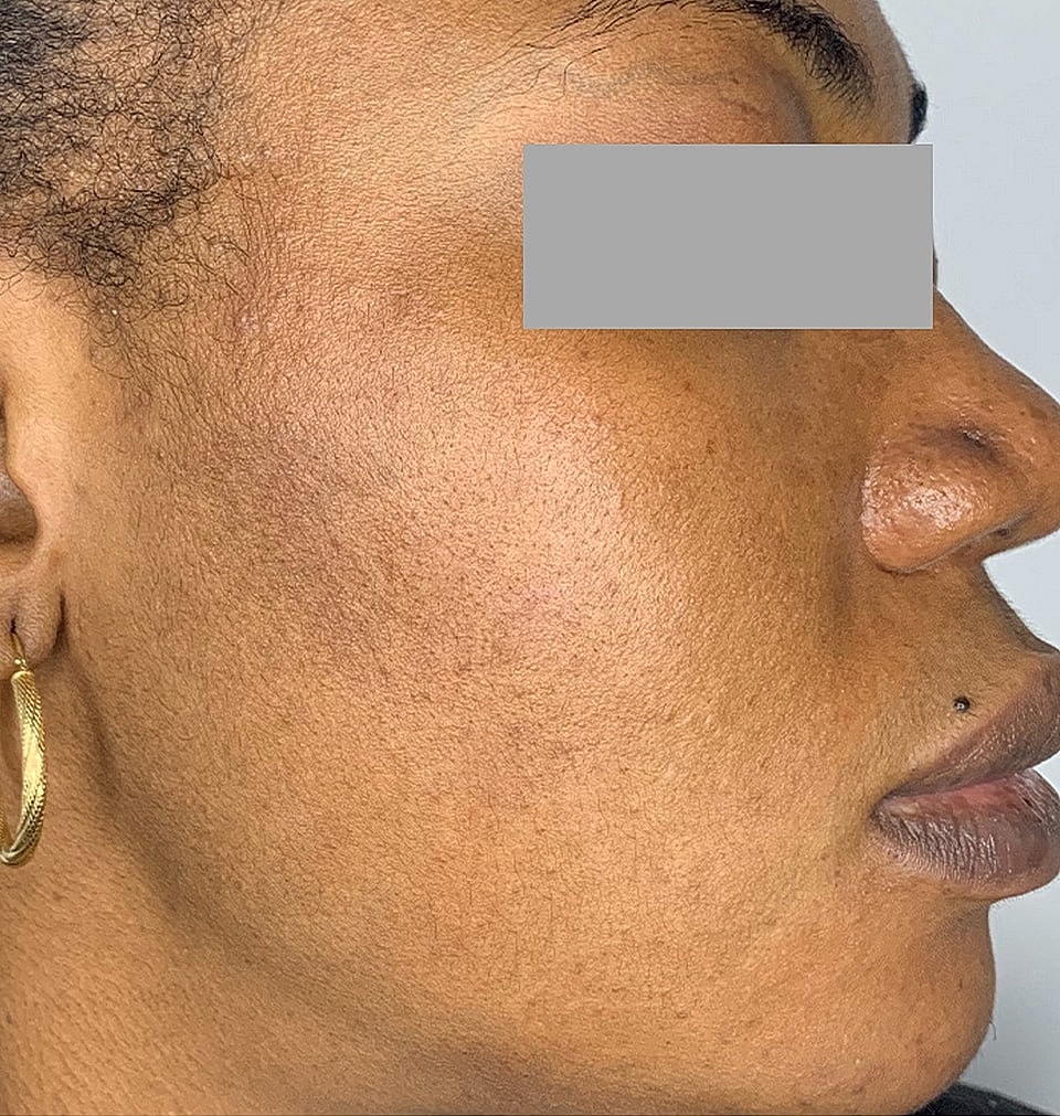 Microneedling With Prp Before & After