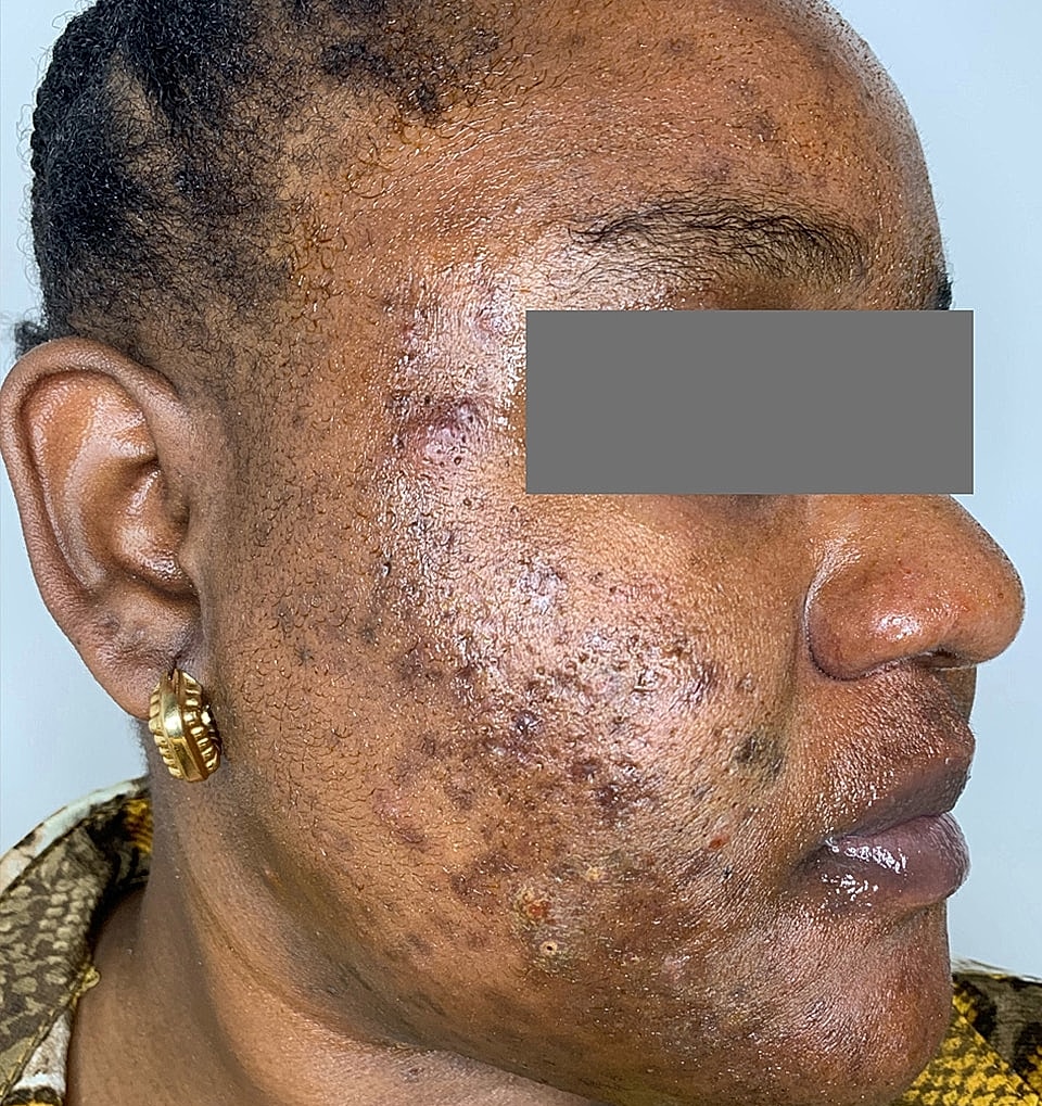 Microneedling With Prp Before & After