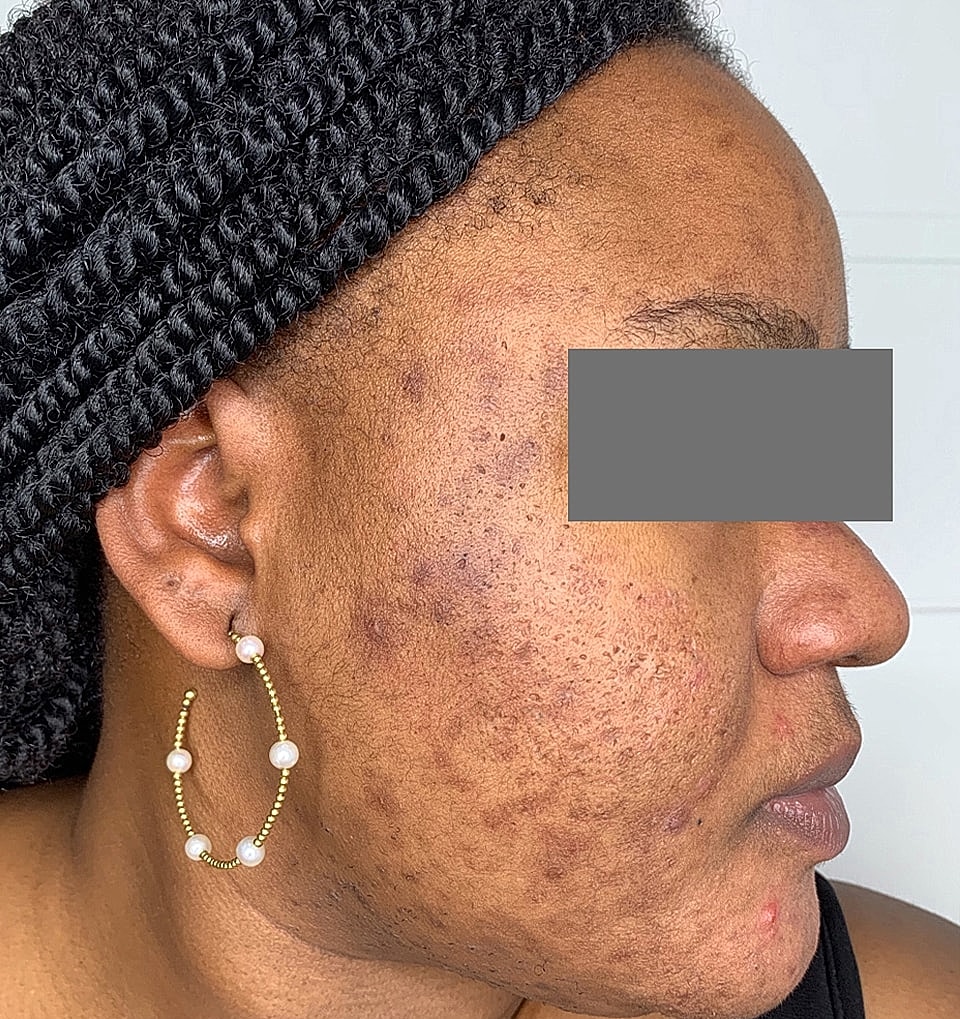 Microneedling With Prp Before & After