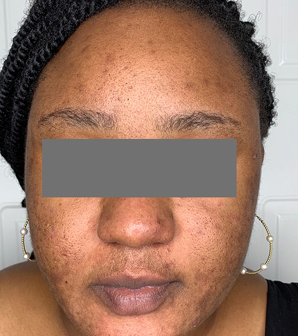 Microneedling With Prp Before & After